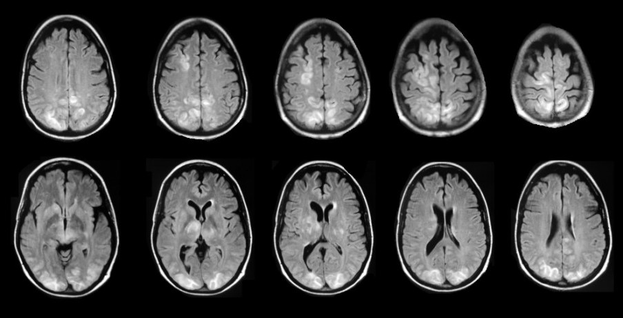 Hypertensive Encephalopathy